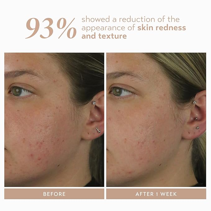 Shani Darden Rescue Serum with 10% Azelaic Complex, Lightweight Hydrating Azelaic Acid Serum for Face with Oat Kernel & Aloe Extracts, Helps Skin Redness & Acne, Non-Comedogenic, Vegan, 1 fl oz