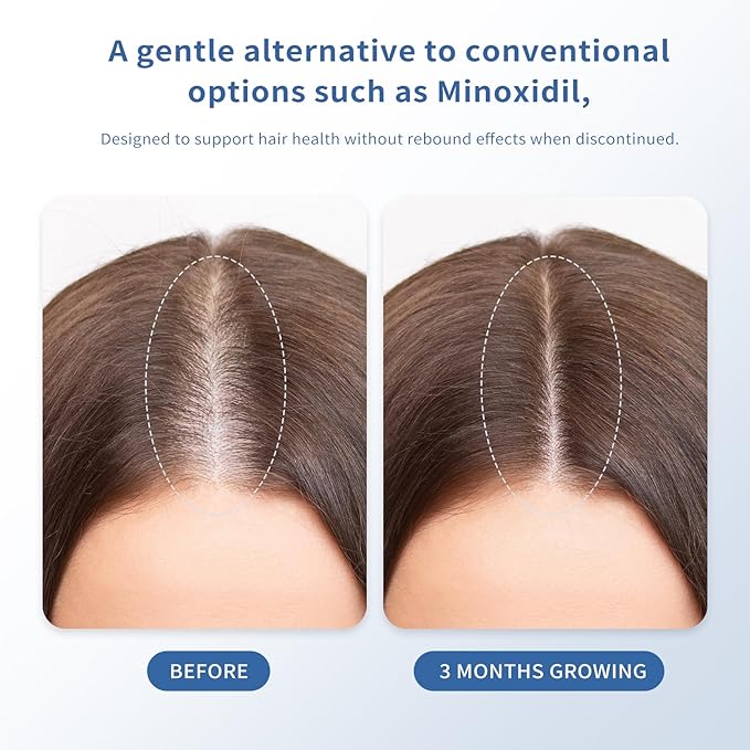 Hair Growth Serum Roll-On 30ml | Patented Blend with 3% Rosemary, 3% Redensyl, 2% AnaGain, Biotin & Niacinamide | No-Rinse, Fast-Absorbing | For Thinning Hair & All Hair Types (1.01 Fl Oz (Pack of 1))
