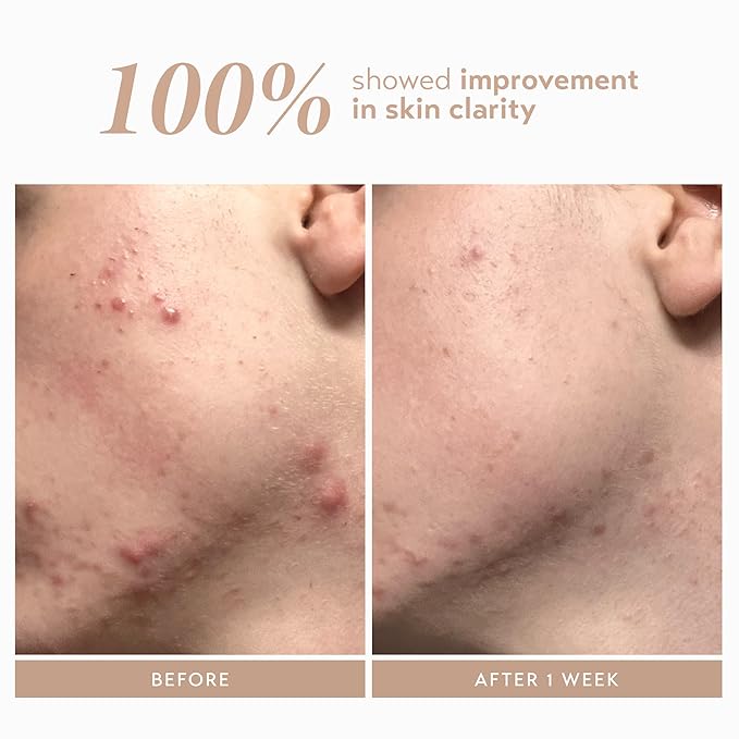 Shani Darden Rescue Serum with 10% Azelaic Complex, Lightweight Hydrating Azelaic Acid Serum for Face with Oat Kernel & Aloe Extracts, Helps Skin Redness & Acne, Non-Comedogenic, Vegan, 1 fl oz