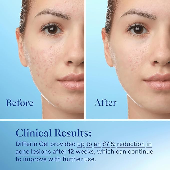 Differin Acne Treatment Gel, 30 Day Supply, Retinoid Treatment for Face with 0.1% Adapalene, Gentle Skin Care for Acne Prone Sensitive Skin, 15g Tube (Packaging May Vary)