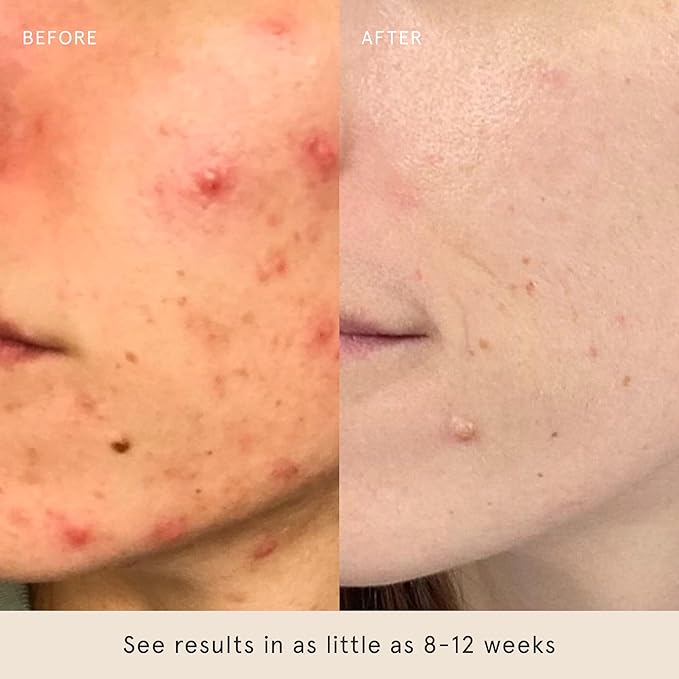 Barefaced Skin Goals Bundle - Toning Pads, Toning Pads II, Liquid Gold, Overachiever - Renew, Resurface, and Revitalize Skin