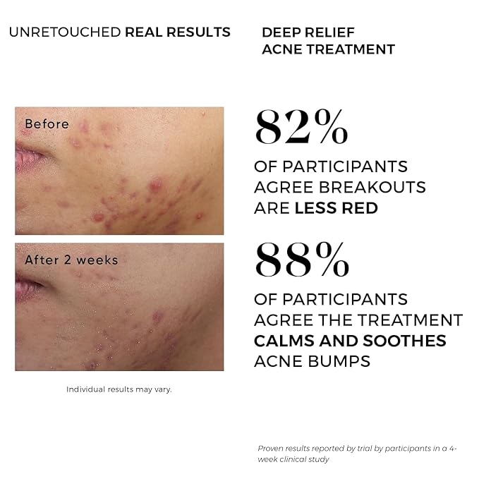 Acne Treatment Pads-Contains Glycolic, Lactic, Salicylic Acid. Eliminates Oily Skin, Clogged Pores & Cystic Breakouts. Removes Dark Spots, Whitehead & Blackhead Pimples for Face & Body.