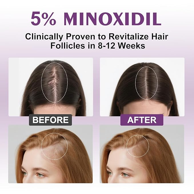 5% Minoxidil Spray for Women-4 PCS ，monoxide for men hair Infused with Biotin, hers hair regrowth treatment, Supports Thicker and Fuller Hair & Beard (13oz, 7 Month Supply)