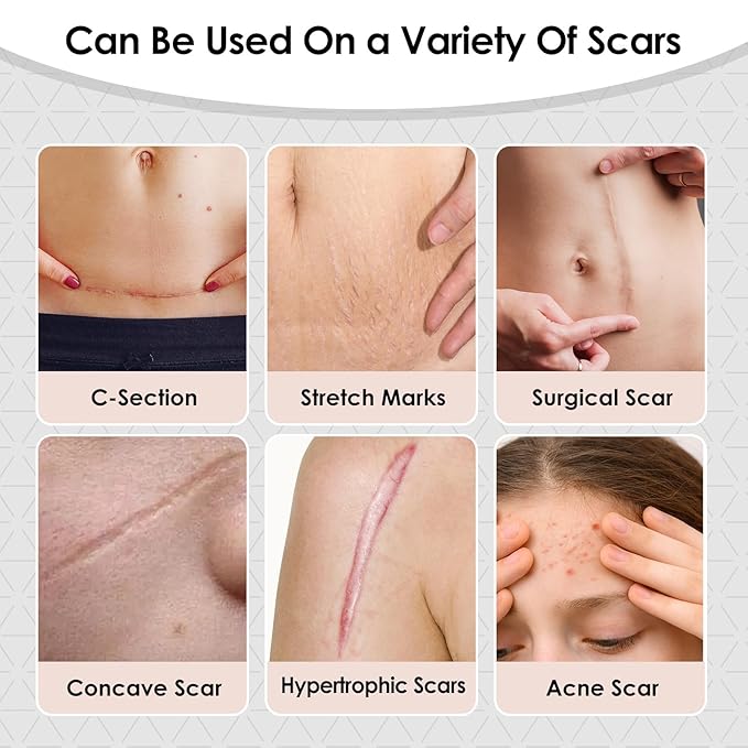 Silicone Scar Sheets,Silicone Scar Tape for Removal Treatment,Medical Grade Scar Tape for Surgical Scars,C-Section,Tummy Tuck,Scar Removal Away(1.6" x 60" Roll - 1.5M) Keloid Bump Removal