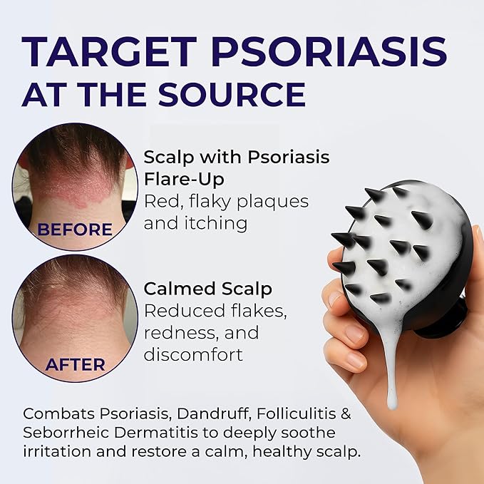 Scalp Psoriasis Shampoo, Flakes Shampoo Anti Dandruff, Itchy Scalp Treatment for Seborrheic Dermatitis & Folliculitis, Anti Fungal, Medicated Solution for Itchy, Flaky & Dry Hairs (Pack of 2)