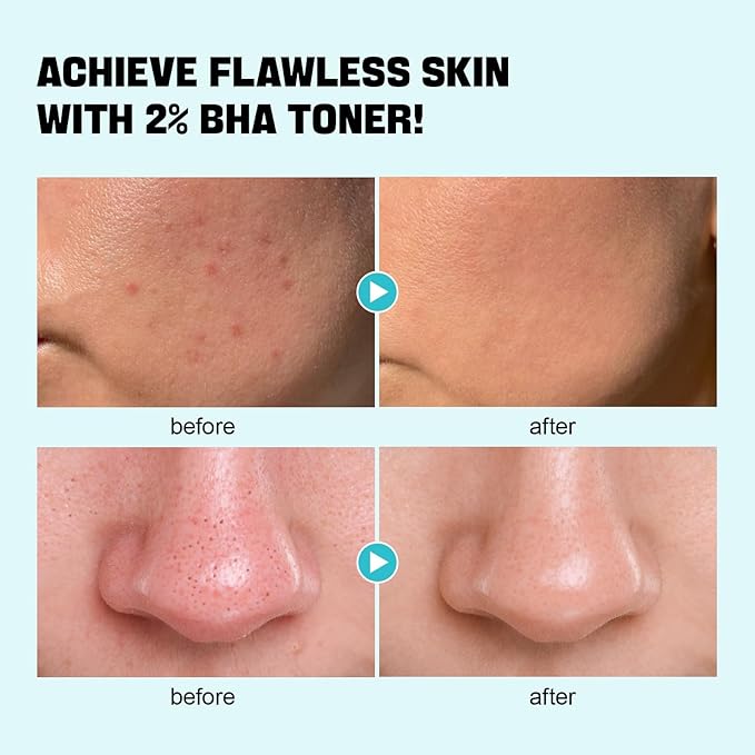 ZealSea 2% Salicylic Acid Toner for Face with 2% Niacinamide - BHA Liquid Exfoliant for Blackheads and Enlarged Pores, Exfoliate for Face to Soothe Breakouts, Exfoliating Toner, 6.76 Fl Oz, Pack of 2