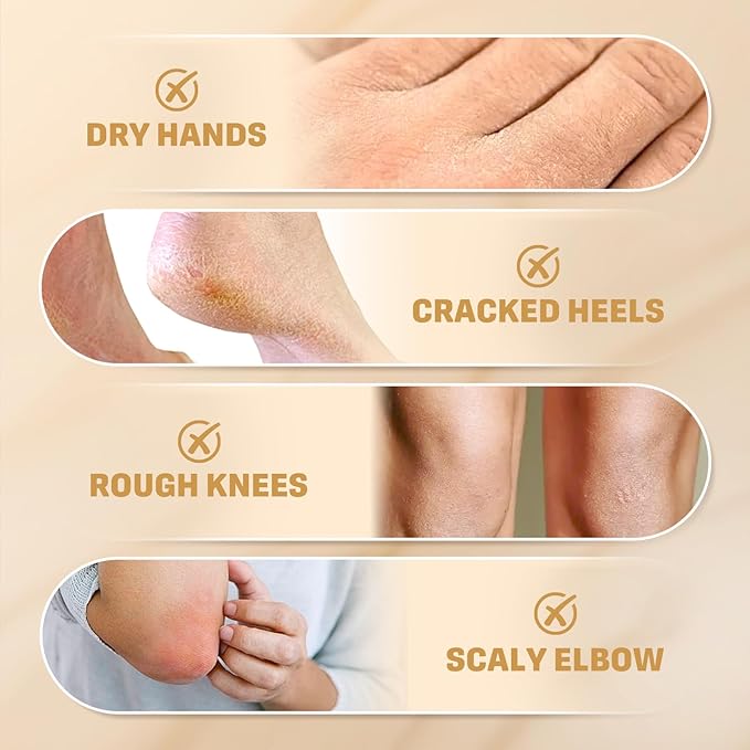 40% Urea Cream with 2% Salicylic Acid, Urea Cream 40 Percent for Feet & Hands- Maximum Strength Moisturizer for Rough, Dry, Thick & Cracked Skin, Callus Remover, Deep Hydration, 150g