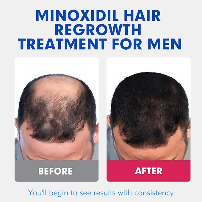 5% Minoxidil for Men, Extra Strength Hair Growth Serum, Beard Growth Oil, Fast Absorbing Dropper, Non Greasy, Low Residue Formula, 2-Pack for 2 Months, Hair Regrowth Treatment for Thinning Hair