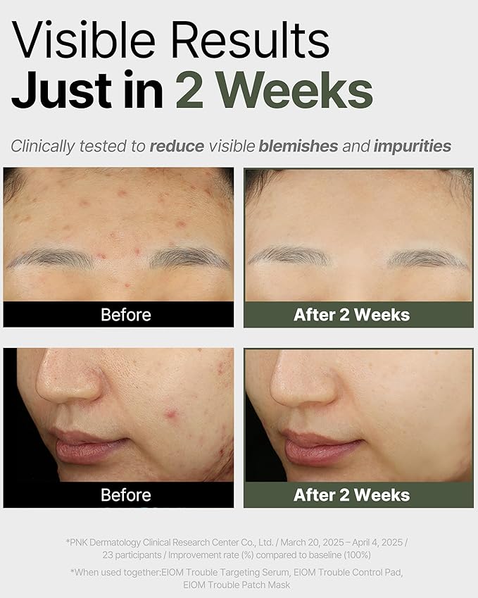 Trouble Patch Mask – Hydrating & Clarifying Korean Sheet Mask with Tea Tree Biome, Pore Vacuum Effect for Sebum & Oil Control, Calming Microbiome Skincare, Stocking Stuffer for Teens | 20ml x 4ea