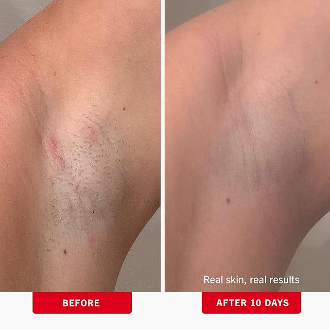 First Aid Beauty - Ingrown Hair Pads with BHA + AHA - Aftershave Treatment Pads to Help Prevent Razor Bumps for Men & Women - Exfoliate Underarms & Bikini Area - Compostable for Daily Use - 60 Pads
