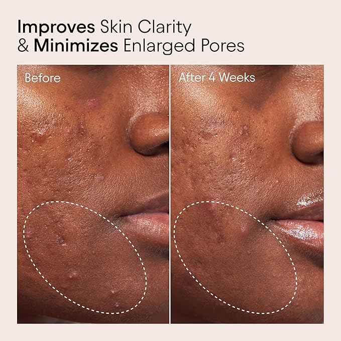Alpyn Pore Perfecting Liquid Toner with 2% BHA & Borage | Liquid Exfoliator to Minimize Pores, Calm & Restore Skin's Natural pH | 4 oz / 120 ml
