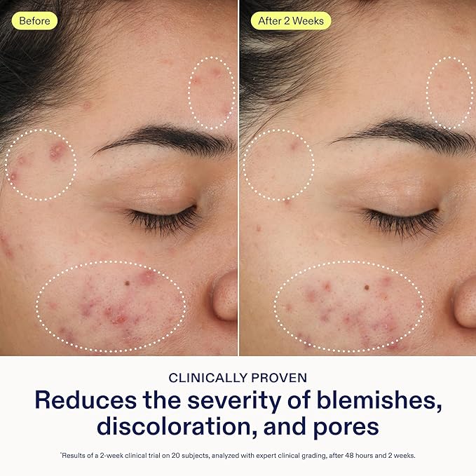 Skinfix 2% BHA Cleanser - 5 oz - Clears Acne Blemishes & Blackheads - Safe for All Types of Acne - Fragrance Free - Vegan, Cruelty Free